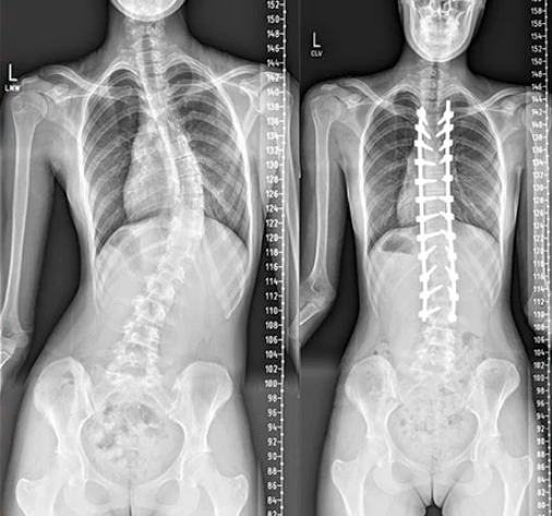 Caso prático: correção de escoliose “C” idiopática toracolombar (antes e depois)
