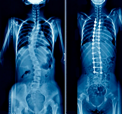 Caso prático: correção de escoliose “S” idiopática dupla-curva (antes e depois)